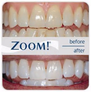 Zoom! Teeth Whitening System, North York Dentist